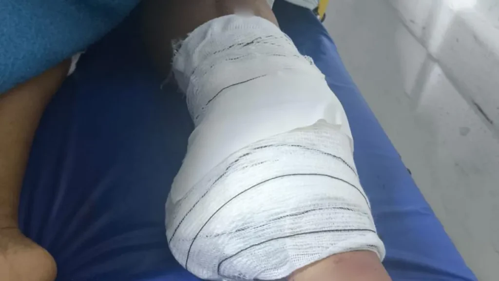 Diarista tem perna amputada após acidente e família busca motorista