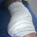 Diarista tem perna amputada após acidente e família busca motorista