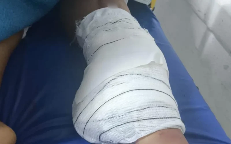 Diarista tem perna amputada após acidente e família busca motorista