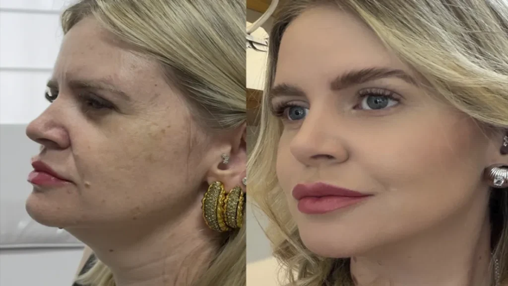 Estética regenerativa: o novo luxo além dos preenchedores