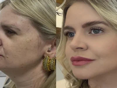 Estética regenerativa: o novo luxo além dos preenchedores
