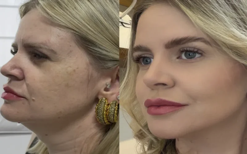 Estética regenerativa: o novo luxo além dos preenchedores
